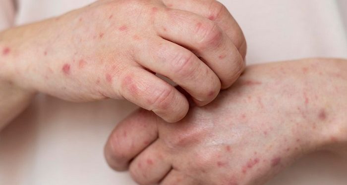 Gangguan Autoimun Sebabkan Peradangan dan Pembengkakan Otot