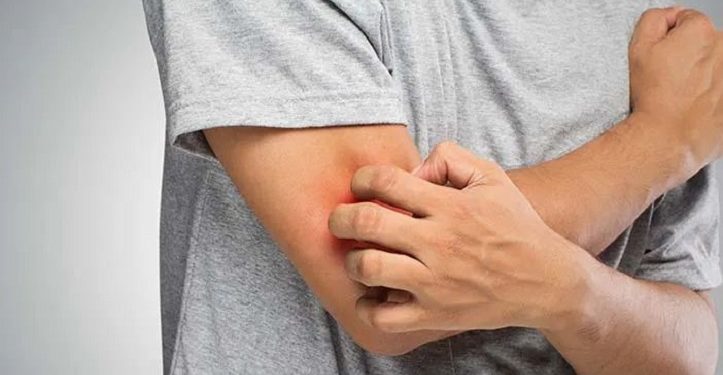 Stress dan Kecemasan dapat Menyebabkan Gatal di Kulit Secara Berlebihan