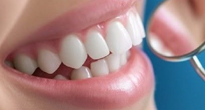 Simak Perbedaan Veneer dan Bleaching Gigi yang Cocok buat Kamu