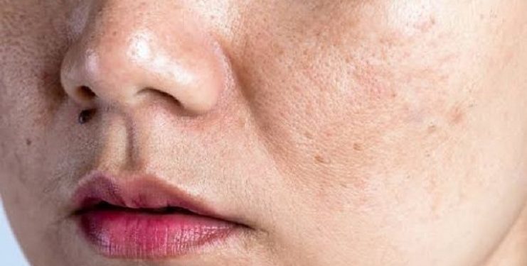 Kesalahan yang Membuat Flek Hitam di Wajah Sulit Pudar